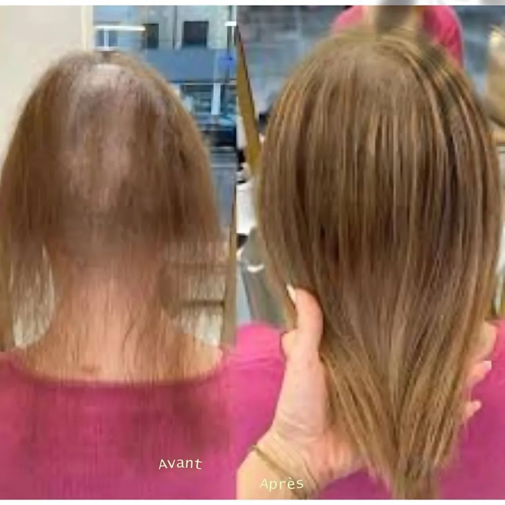 Avant et après : cheveux clairsemés puis chevelure plus dense, vue de dos